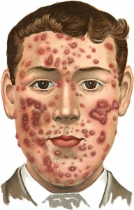 491px-An_introduction_to_dermatology_(1905)_Acne_(indurta)